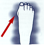 pain-bunions.png