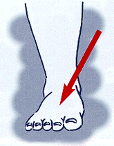 pain-neuroma.png
